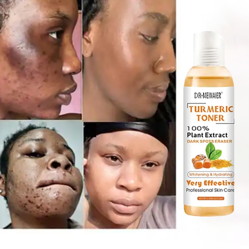 Wholesale Dark Spots Toner Spots Eraser Corrector Cdes Blemishes Dark Spots Remover Acne Tumeric Skin Face Toner