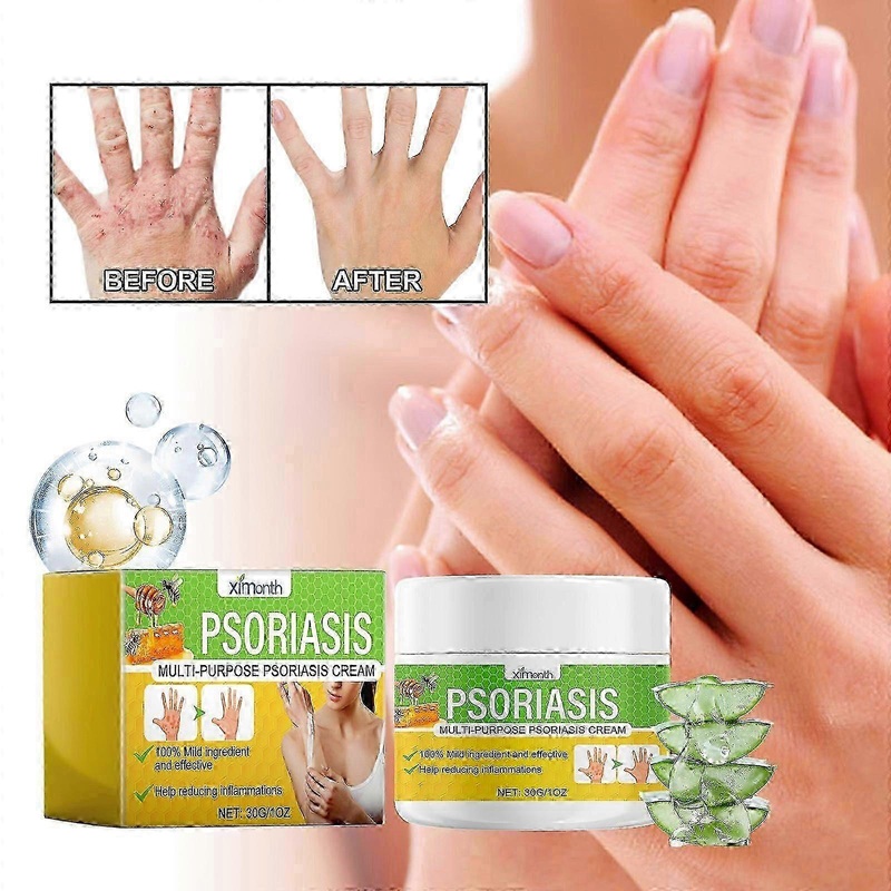 Skin care cream, psoriasis care cream, relieve the body skin itching, red pain, moisturizing skin anti-itch care cream
