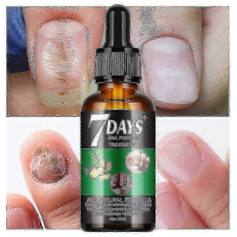 1-3pcs 7 Days Nail Fungus Treatment, 7 Days Nail Growth and Strengthening Serum Nail, Nail Repair Solution, Restoring Healthy Nails 2025