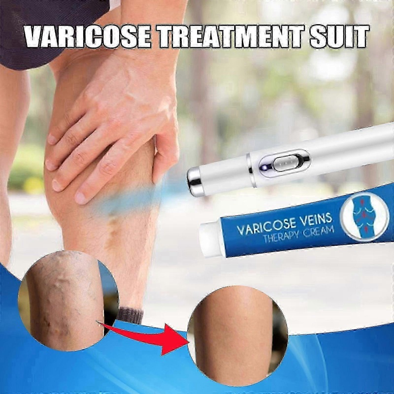 Varicose Vein Treatment Cream Varicose Vein Ointment Treatment Of Varicose Veins