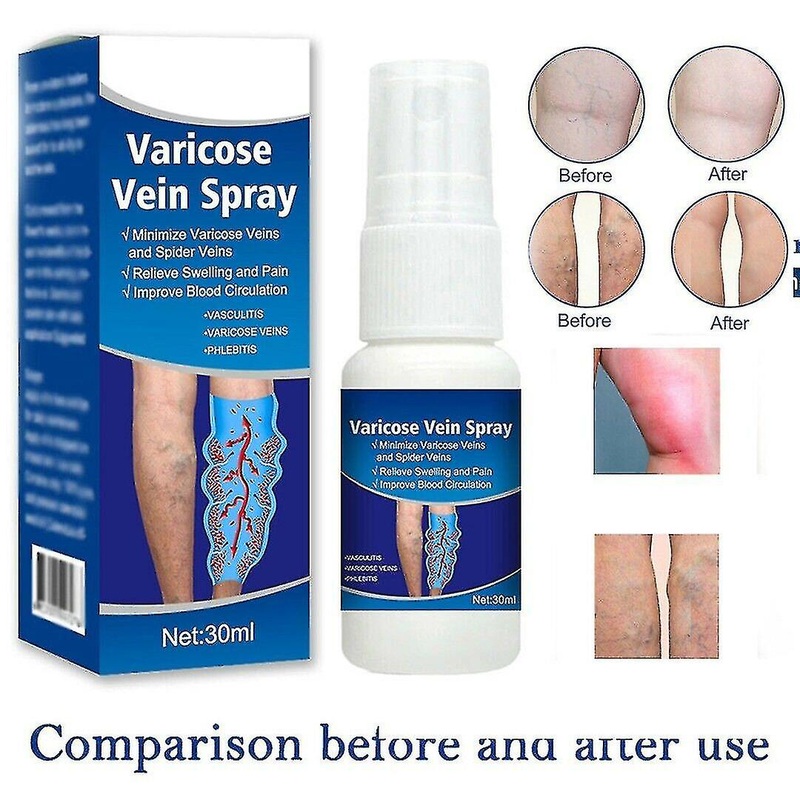 Varicose Veins Soothing Spray Relief Phlebitis Angiitis Vein Treatment Spray 30ml